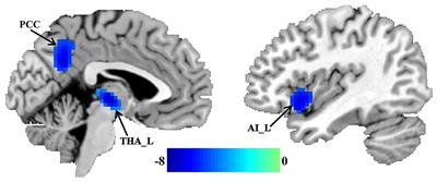 Abnormal Whole Brain Functional Connectivity Pattern Homogeneity and Couplings in Migraine Without Aura